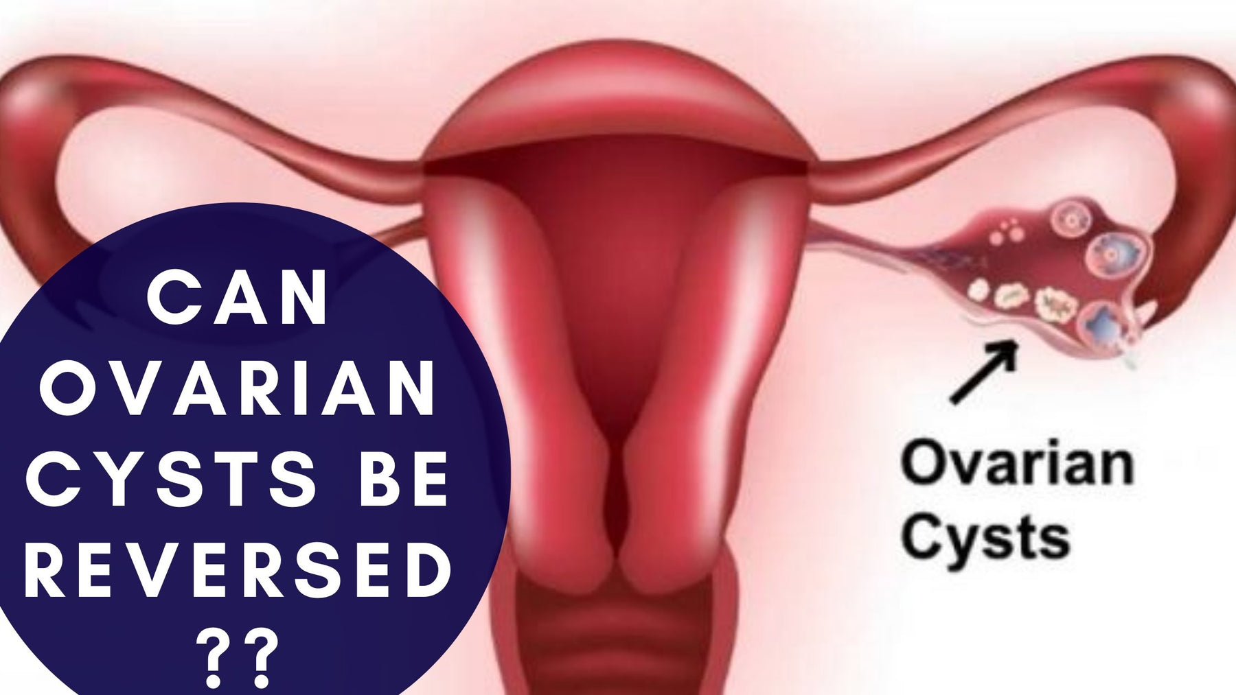 Can ovarian cysts be reversed? | Roshni Sanghvi