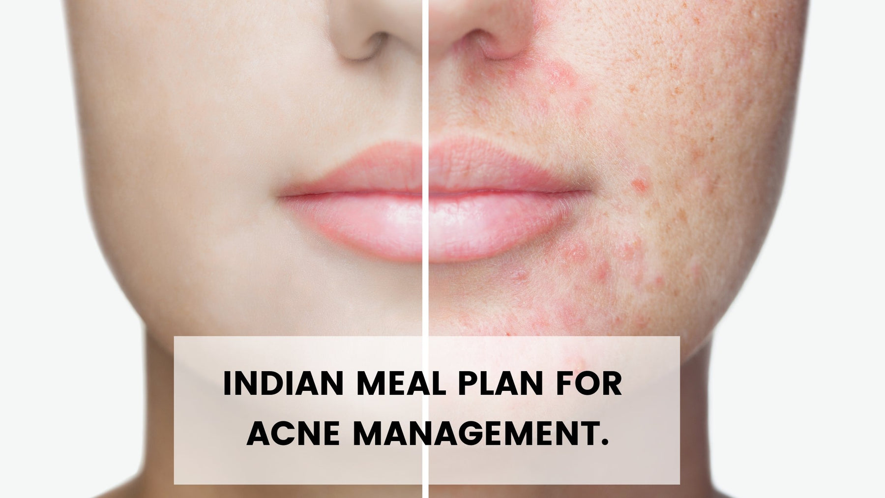 Indian Diet For Acne-Free Skin | Roshni Sanghvi