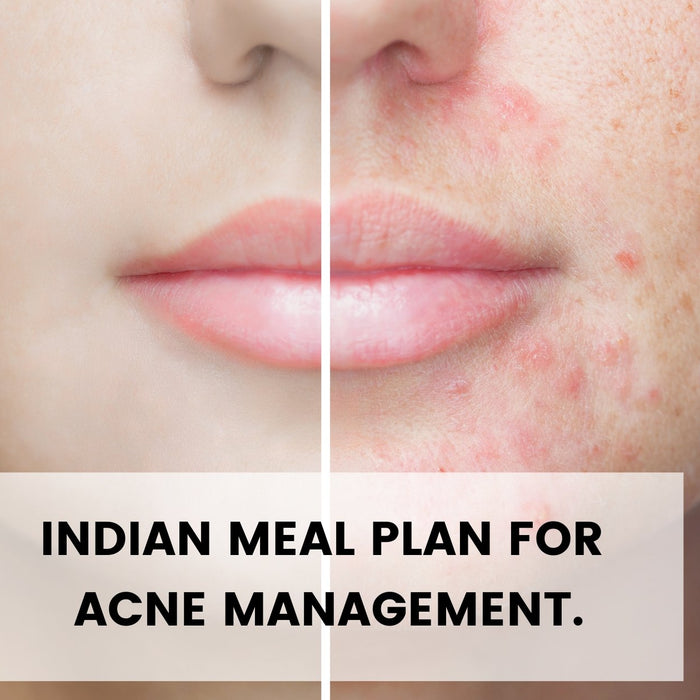 Indian Diet For Acne-Free Skin | Roshni Sanghvi